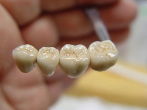Protezirovanie-zubov-metallokeramika4